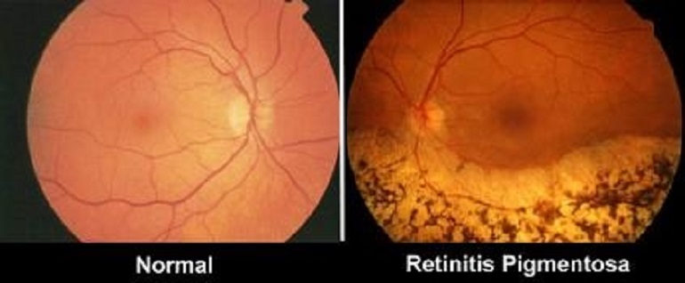 retinitis-pigmentosa