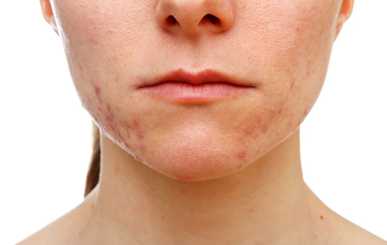 acne_salud