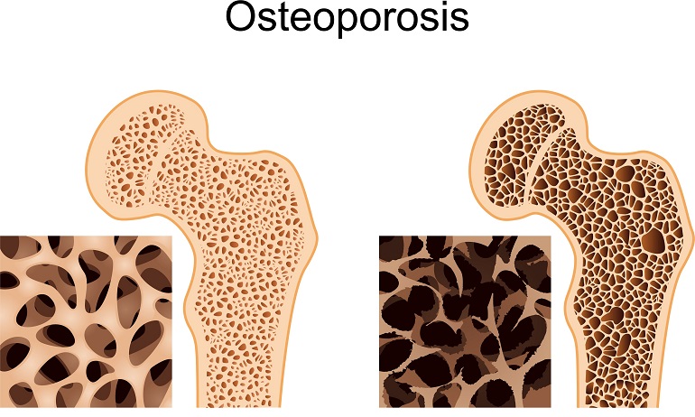 osteoporosis_imss_guerrero